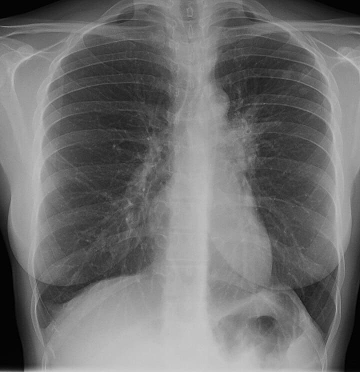 radiografie tuberculoză